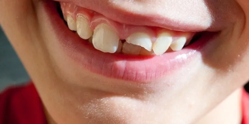 Giấc mơ về việc rụng răng cửa