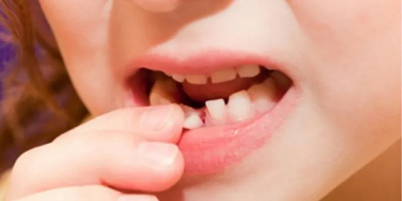 Nằm mơ rụng răng cửa