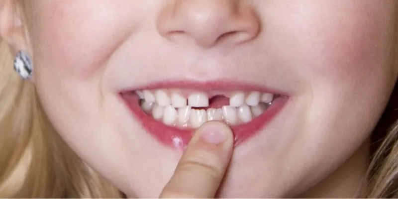 Con số lô đề thần kỳ liên quan đến giấc mơ rụng răng